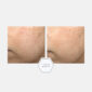 30307_neo_post_acne_mark_correcting_serum_v5.jpg