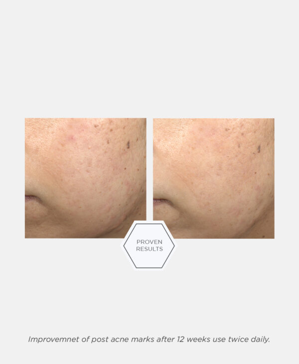 30307_neo_post_acne_mark_correcting_serum_v5.jpg 30307_neo_post_acne_mark_correcting_serum_v5.jpg