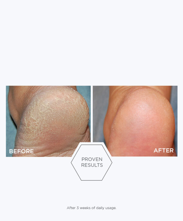 30154_neostrata_problem_dry_skin_cream_v6_.jpg Bilden representerar resultatet av avändning av neostrata produkt.